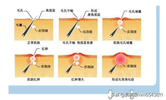 硬痘痘怎么消除挤不动(图4)