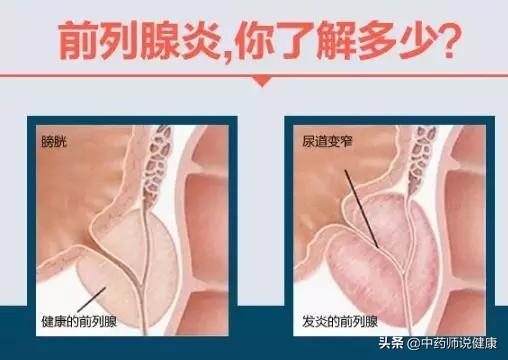 男人前列腺炎是怎么引起的(图2)