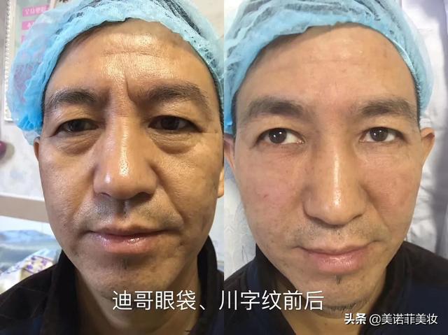 如何去川字纹(如何改善川字纹)
