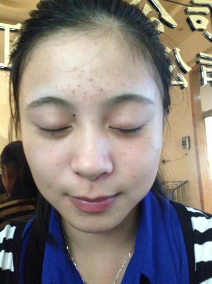 脸上长痘痘怎么去掉痘痘(图21)