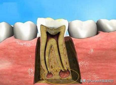 牙齿老是隐隐作痛?到底是犯了什么牙病