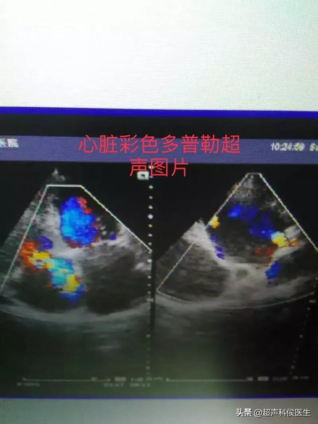 什么是彩色(什么是彩色多普勒超声)