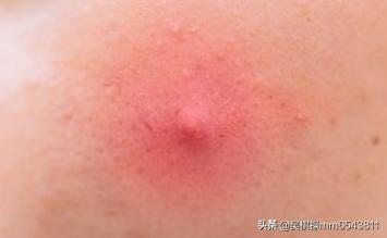 硬痘痘怎么消除挤不动