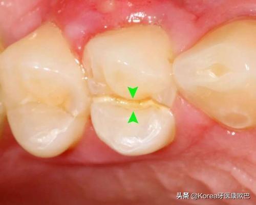 牙齿老是隐隐作痛?到底是犯了什么牙病