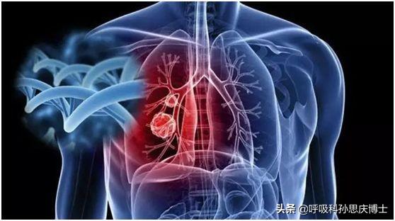 肺结节是什么病呢