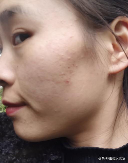 脸上长痘痘怎么去掉痘痘(图14)