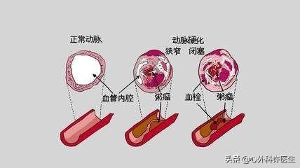 孕妈习惯救宝宝一命（冠心病是怎么回事？）