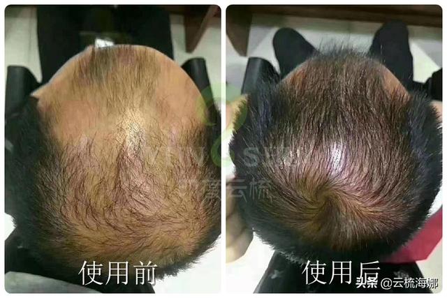 掉头发严重怎么改善(图4)