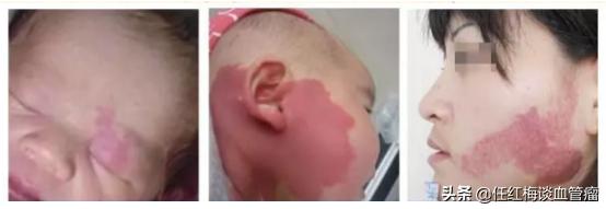 鲜红斑痣怎么治疗(图1)